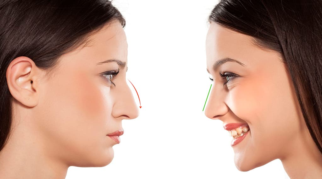 Hiko Nose Lift Threads VS Fillers