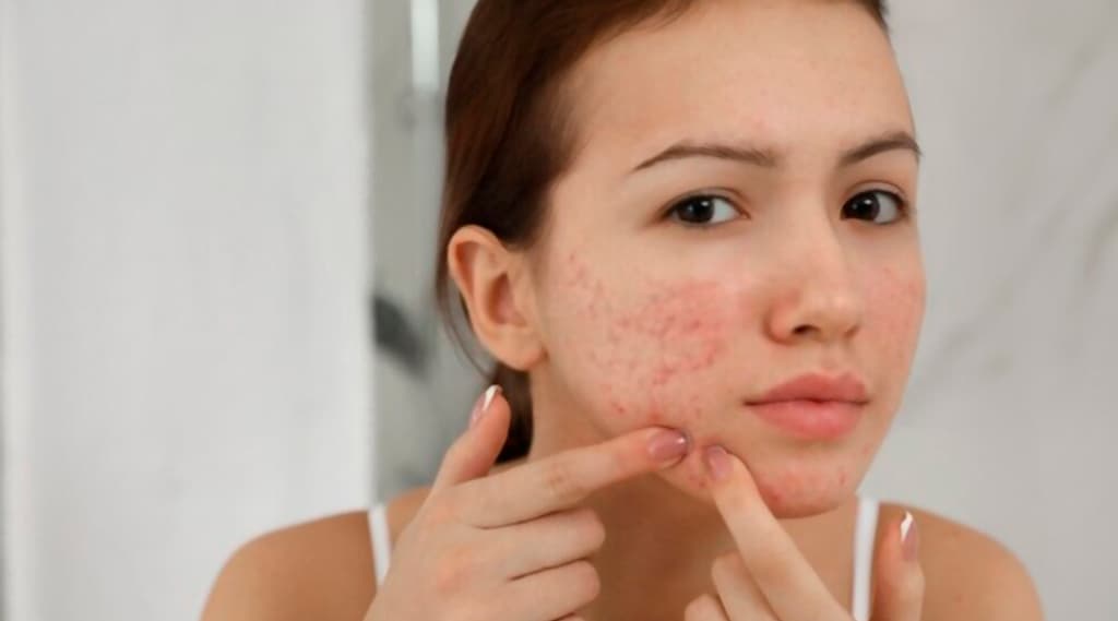 Winning the Battle Against Acne: Understanding Treatments and When to Seek Professional Help