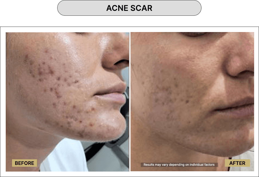 Acne Scar