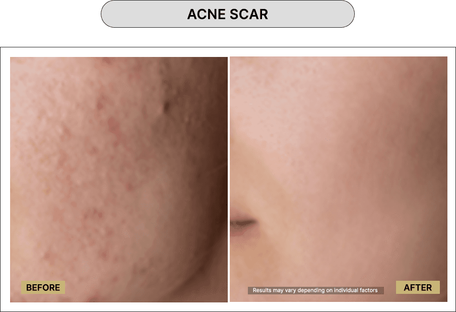 Acne Scar