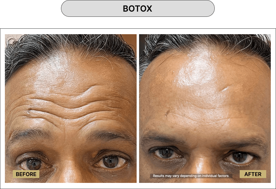 Botox