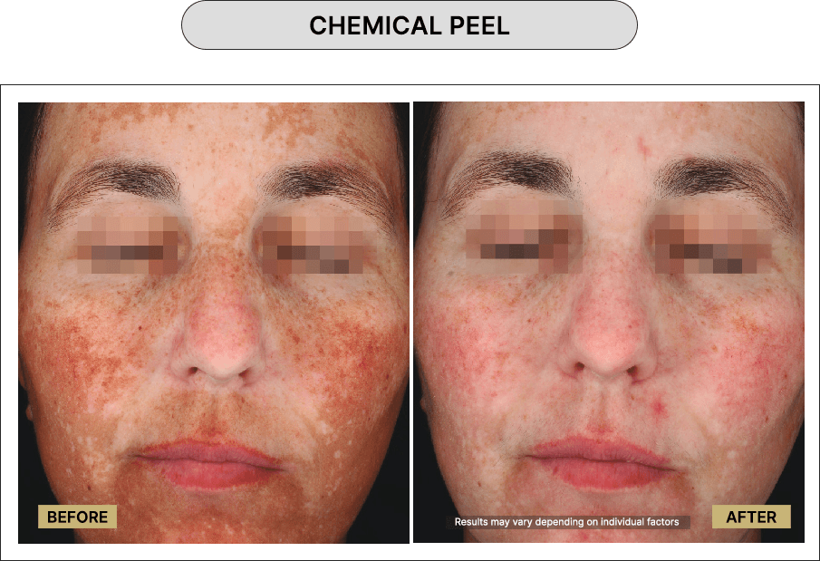 Chemical Peel