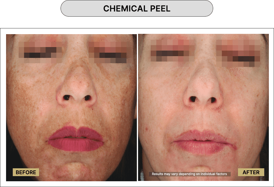 Chemical Peel
