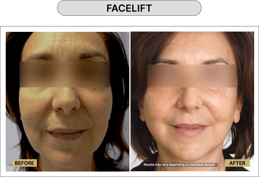 Facelift