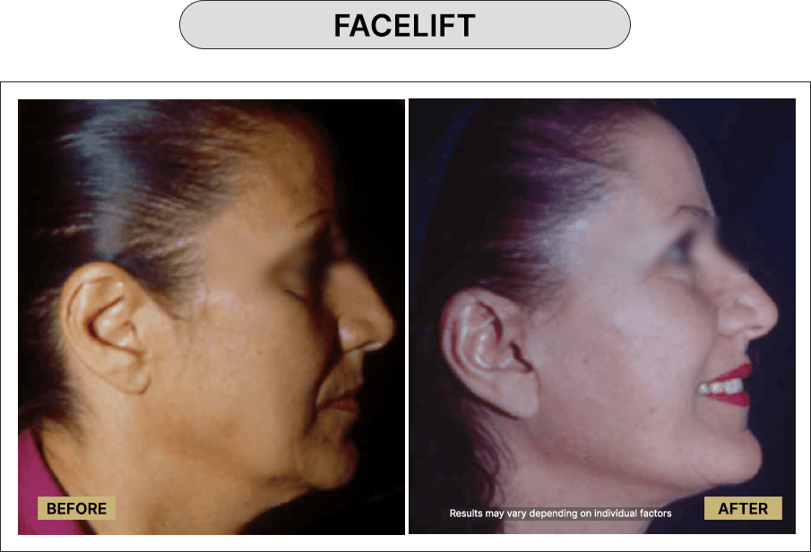 Facelift