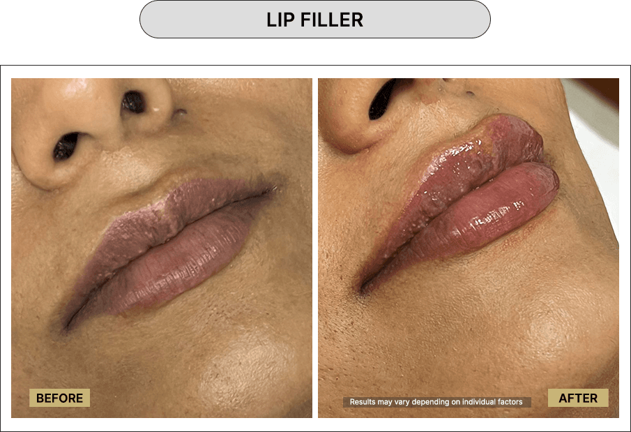 Filler