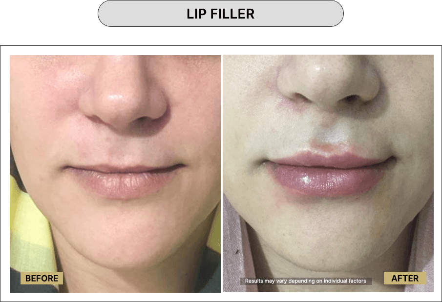 Filler