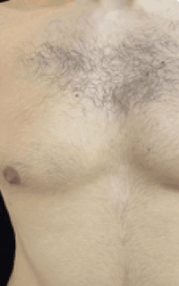 Skin111