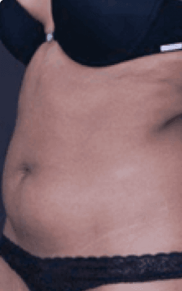 Skin111