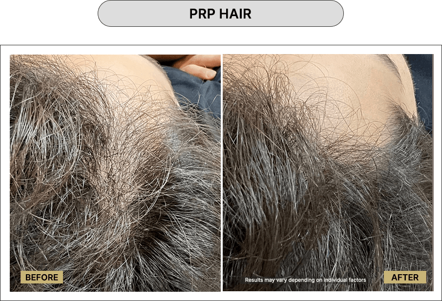 PRP hair