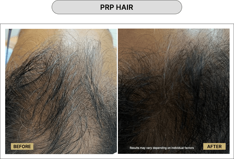 PRP hair