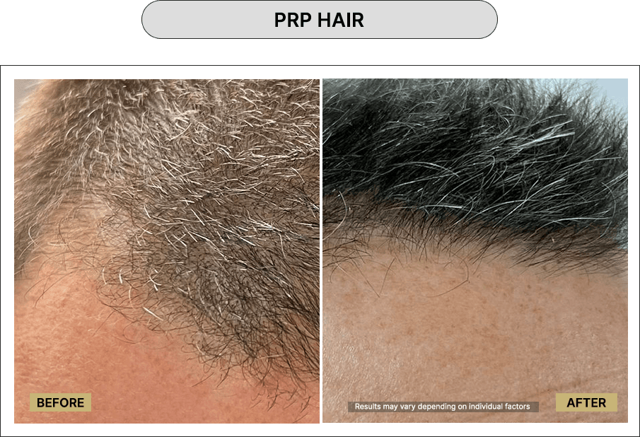 PRP hair