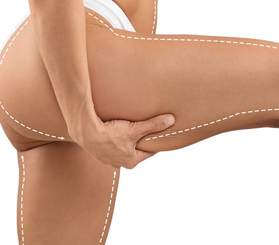 Thigh Lift