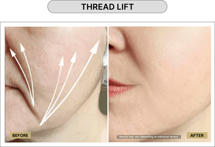 Thread Lift