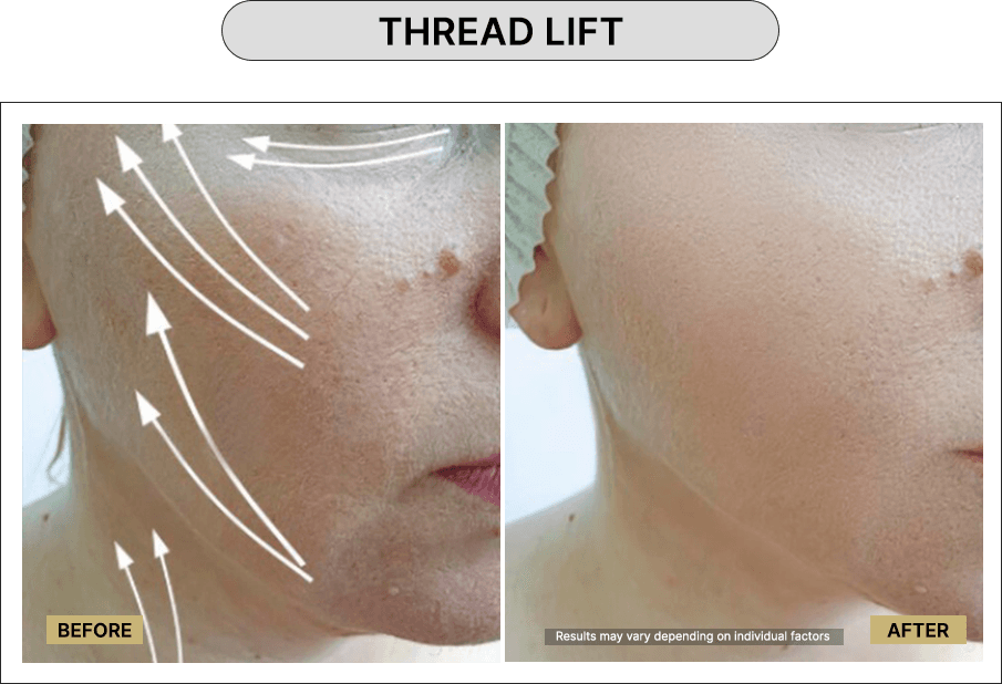 Thread Lift