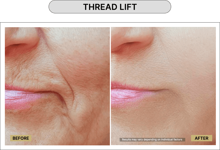 Thread Lift