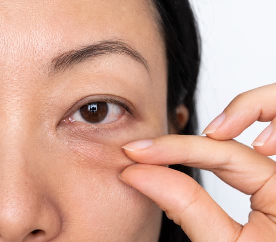 Under eye closeup