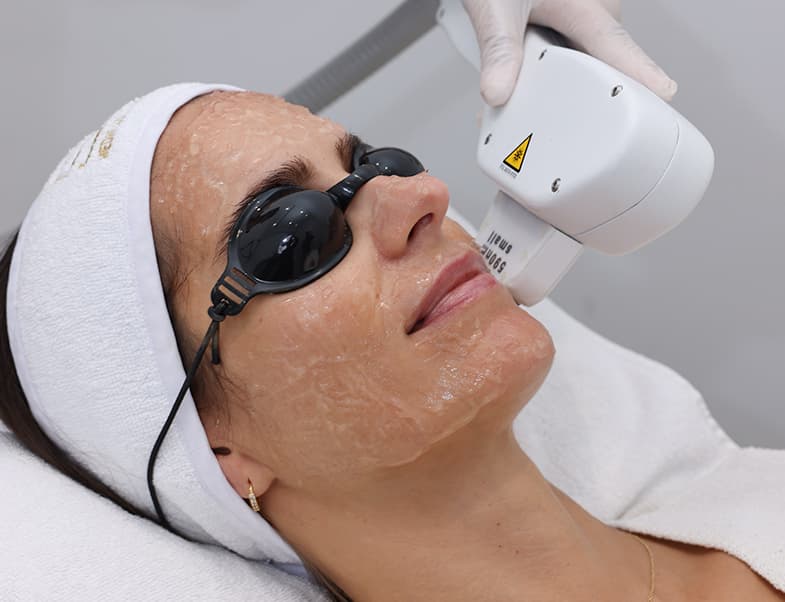 Laser hair removal
