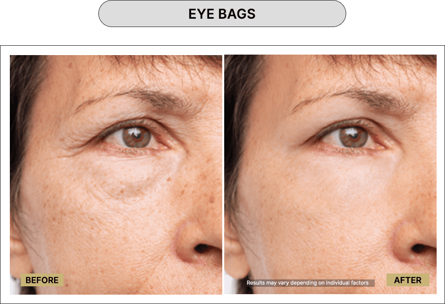 Eye bags