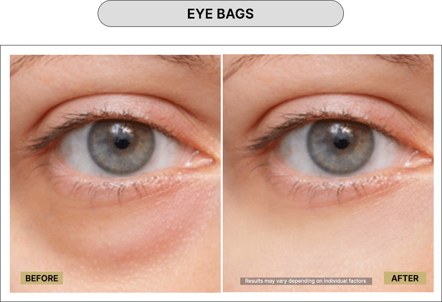 Eye bags