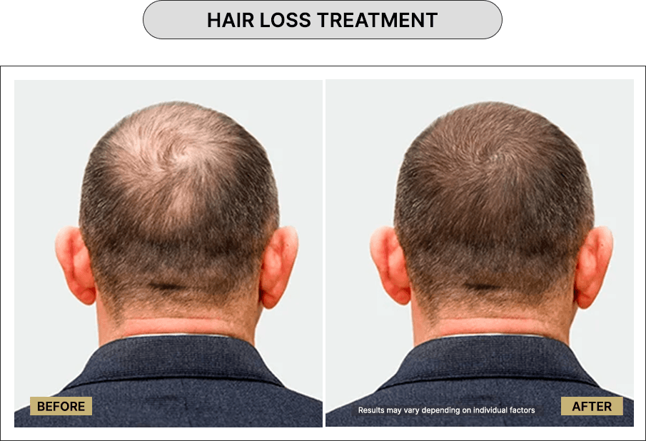 Hair loss treatment