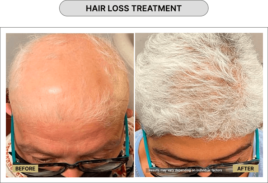 Hair loss treatment
