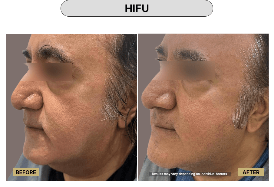 HIFU