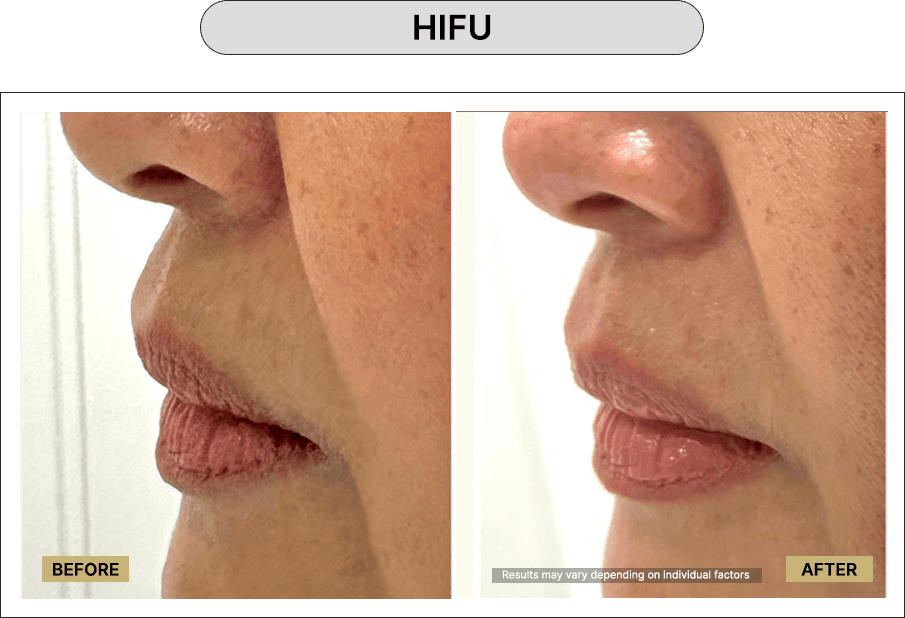 HIFU
