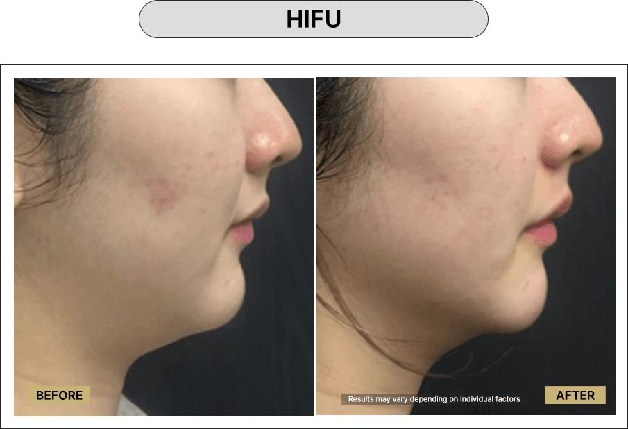 HIFU