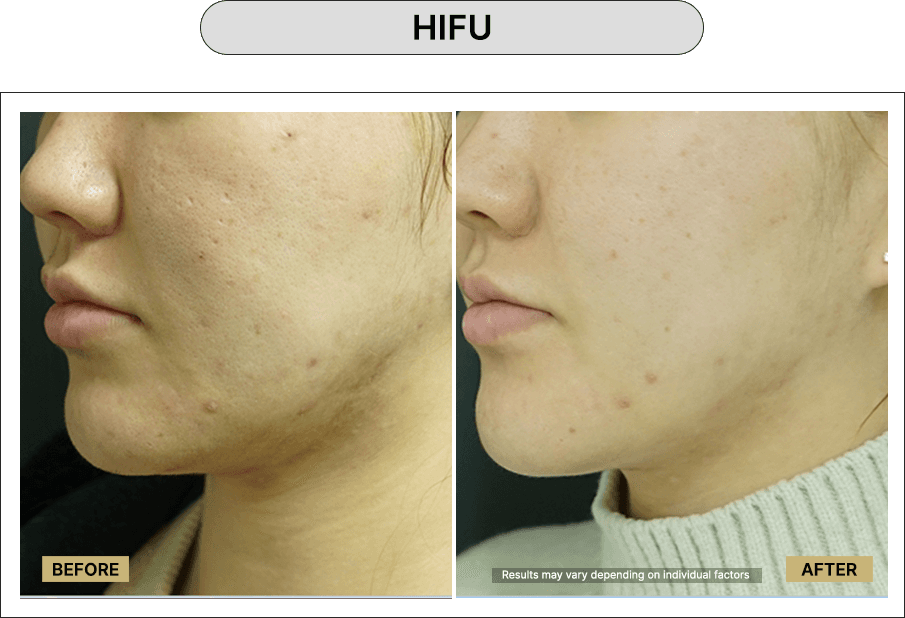 HIFU