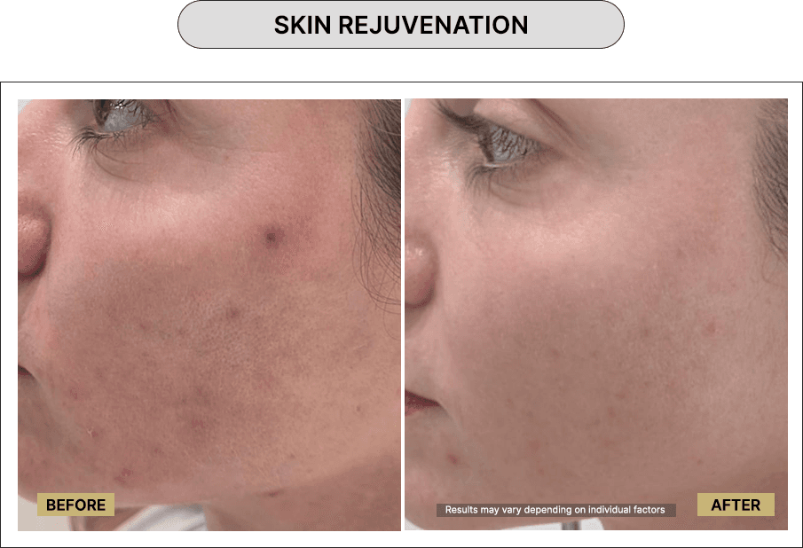 Skin Rejuvenation