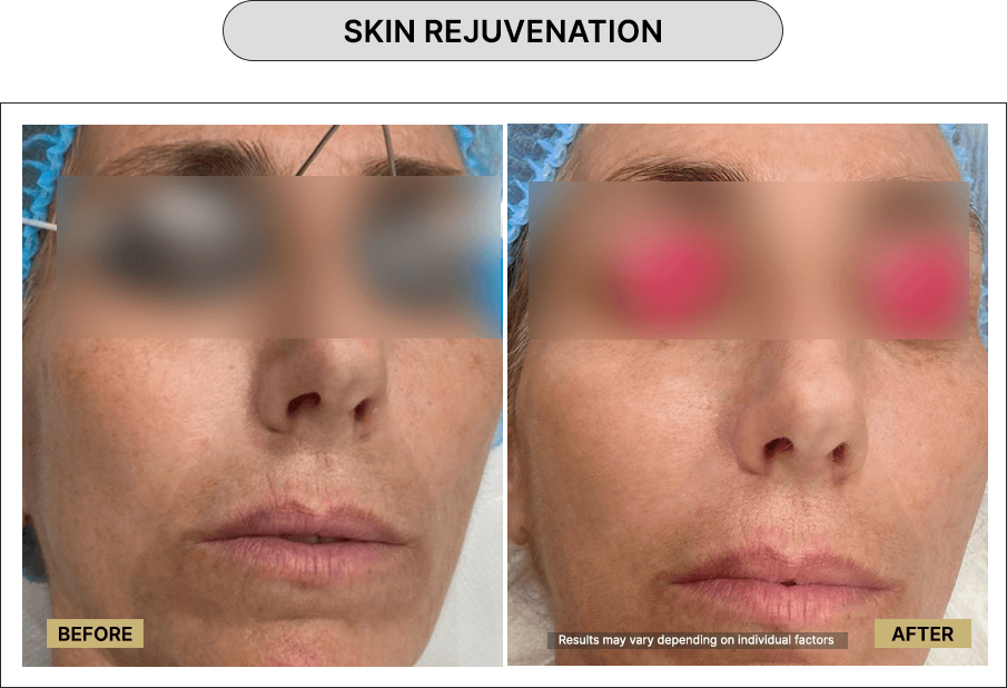 Skin Rejuvenation