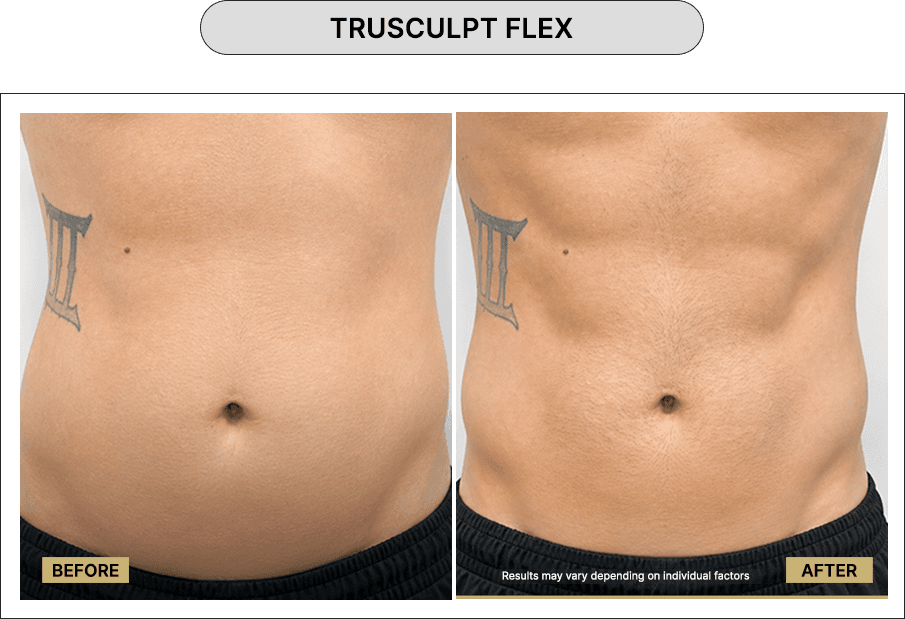 Trusculpt Flex
