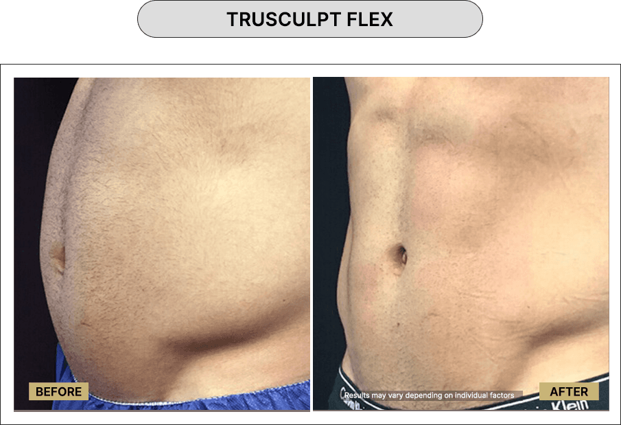 Trusculpt Flex