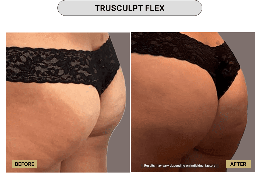 Trusculpt Flex