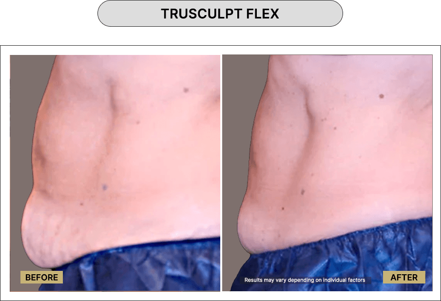 Trusculpt Flex