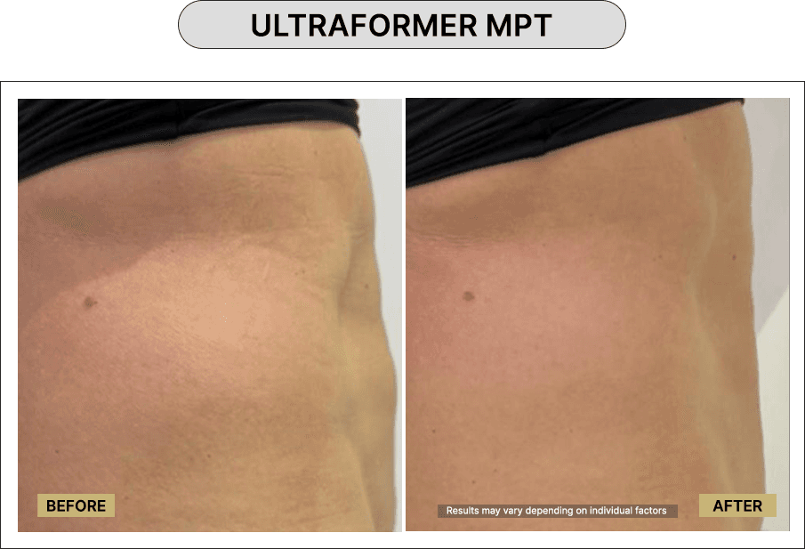 Ultraformer MPT