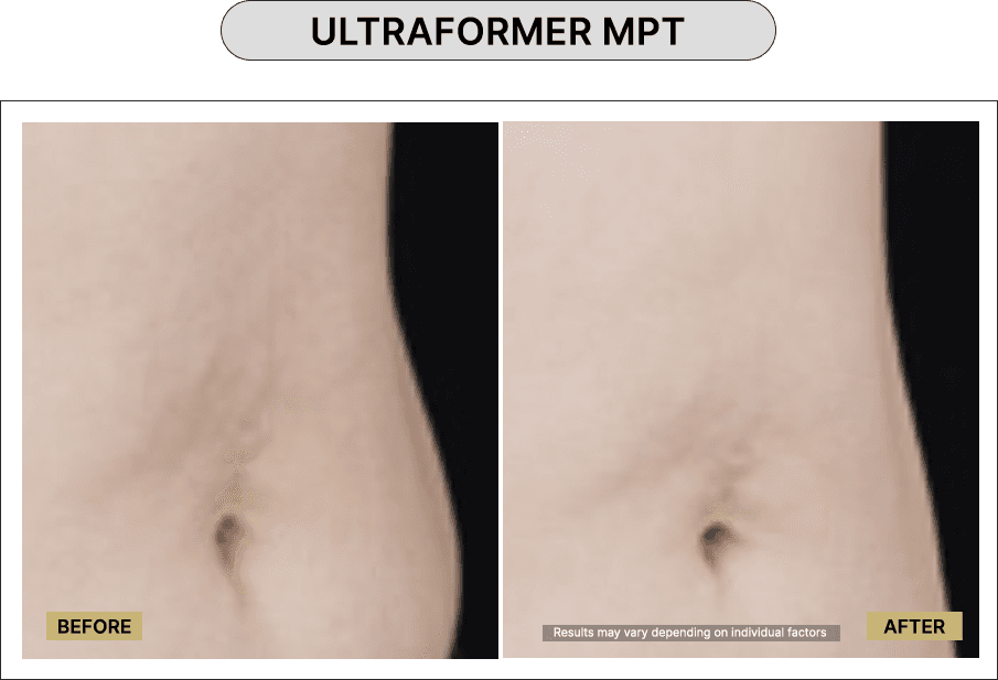 Ultraformer MPT