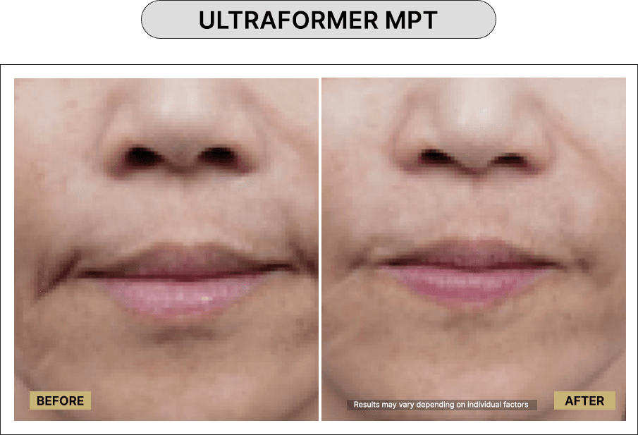 Ultraformer MPT