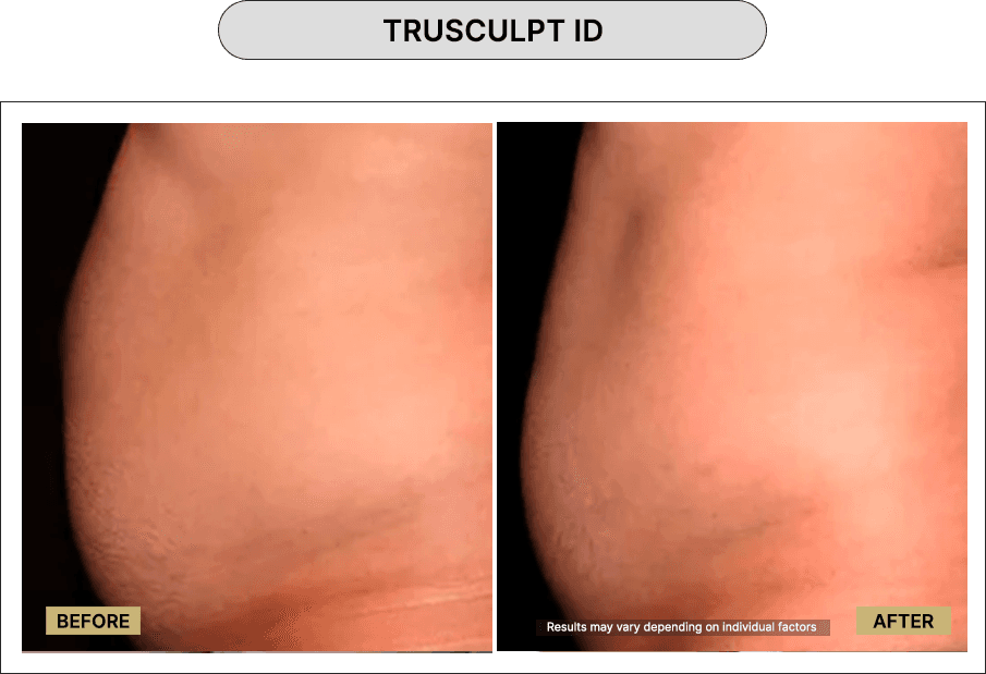 Trusculpt ID