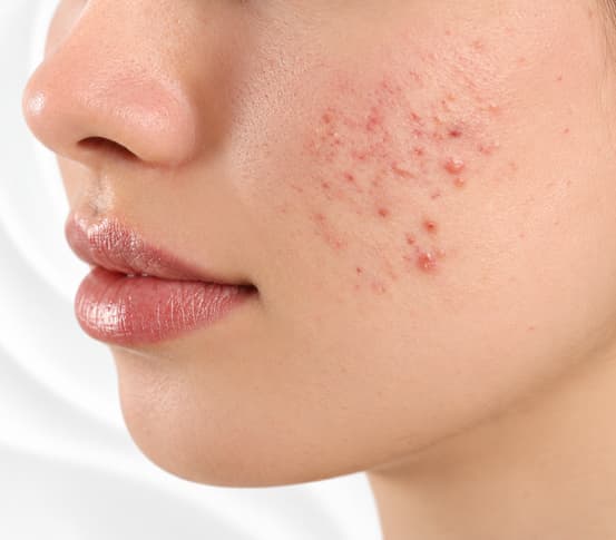 Acne Closeup