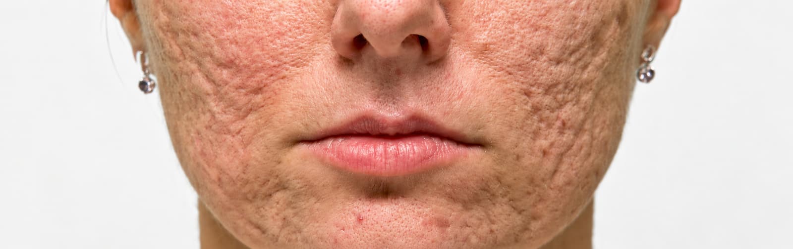 Skin111