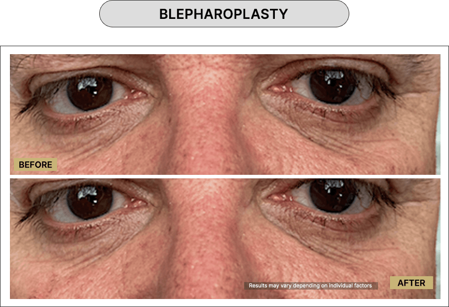 Blepharoplasty
