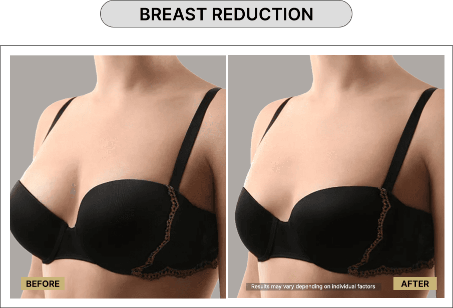 Breast Reduction