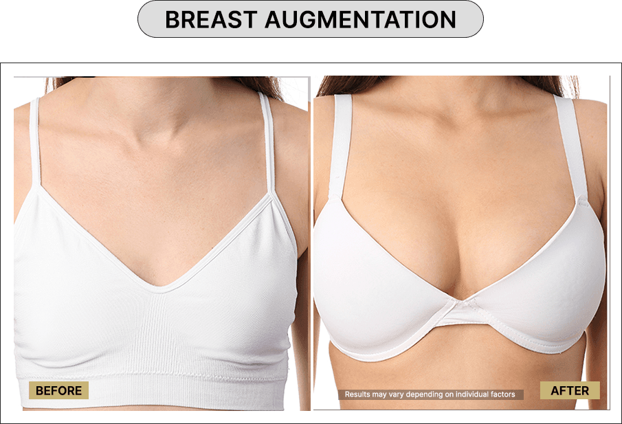Breast Augmentation