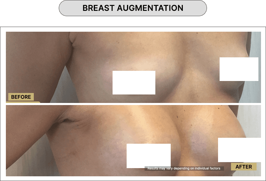 Breast Augmentation