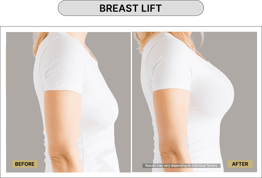 Breast lift