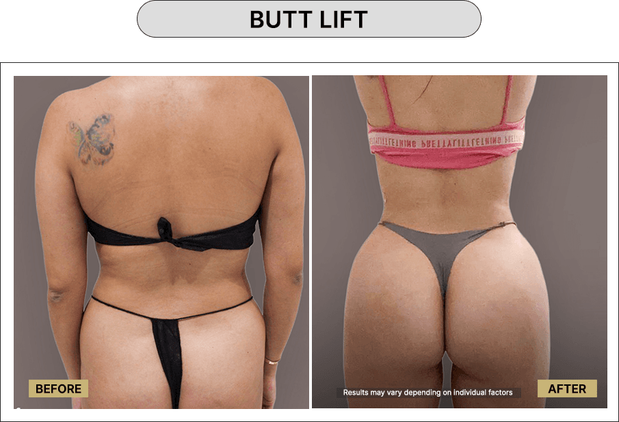 Butt Lift