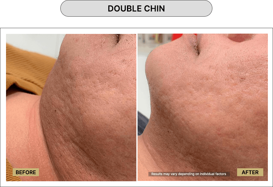 Double Chin