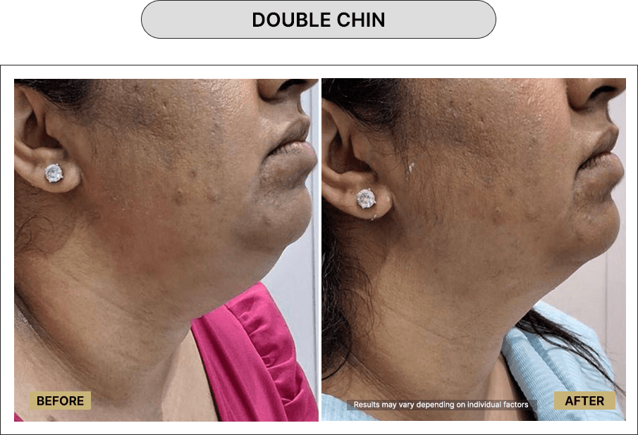 Double Chin